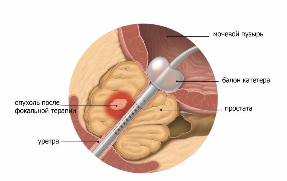 Брахитерапия предстательной железы: Все, что нужно знать о процедуре