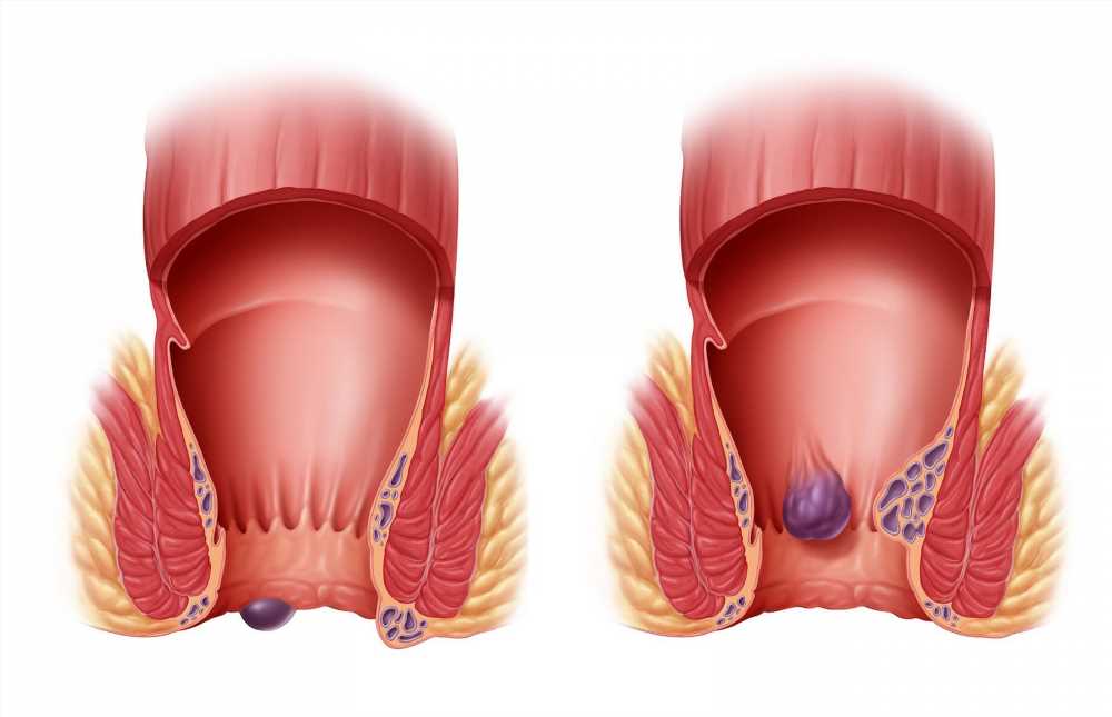 Геморрой: Почему лечение необходимо начать немедленно