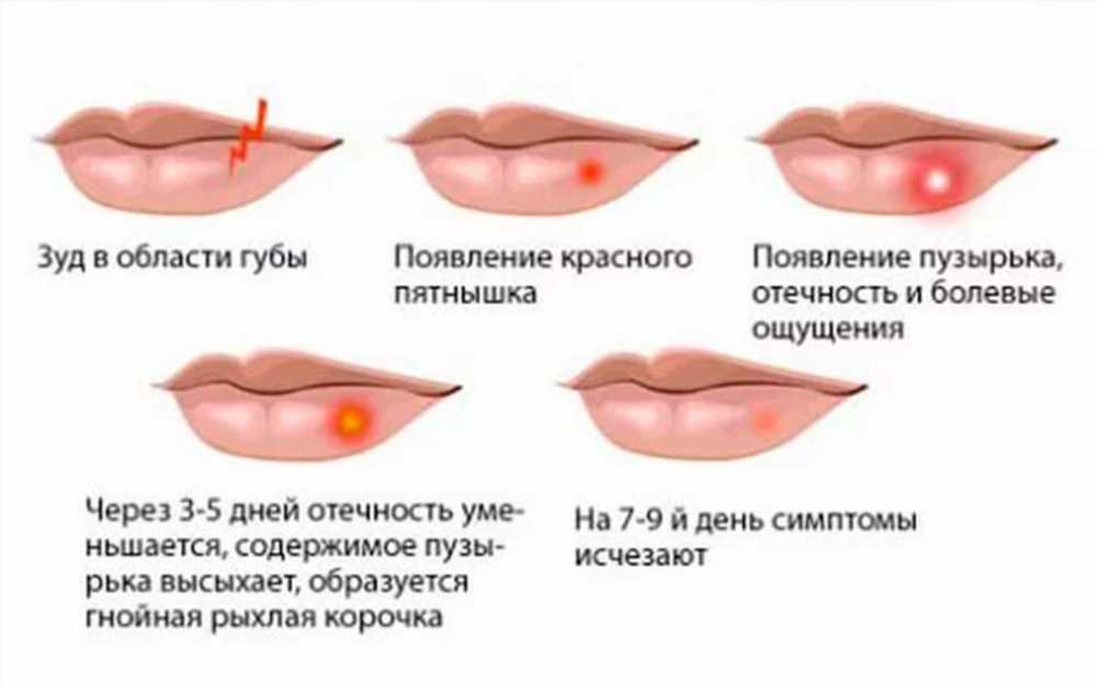 Герпес при беременности: признаки, лечение, профилактика и герпес у новорожденных