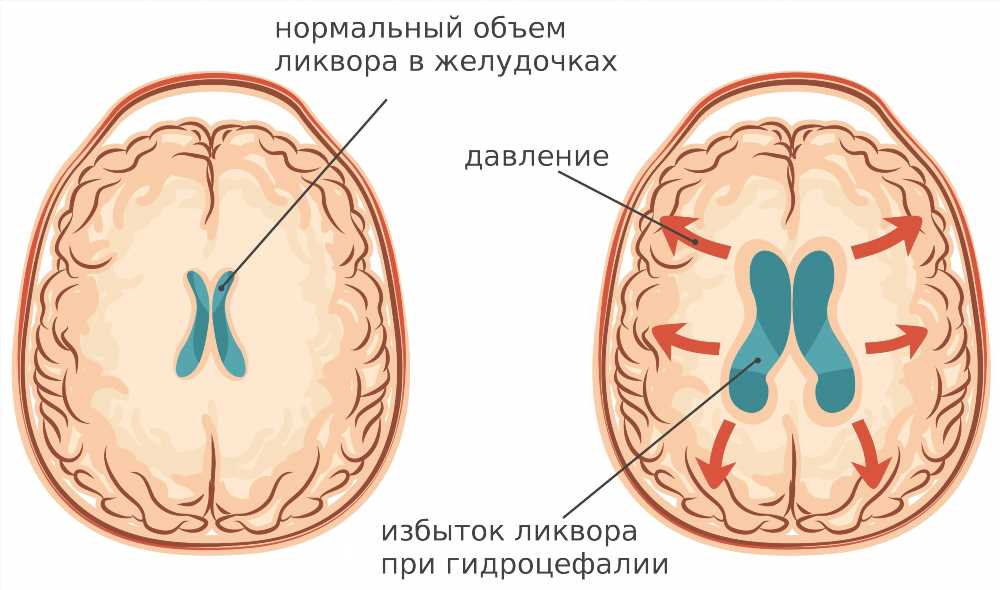 Гипертензионно-гидроцефальный синдром у грудничка: причины, симптомы и лечение