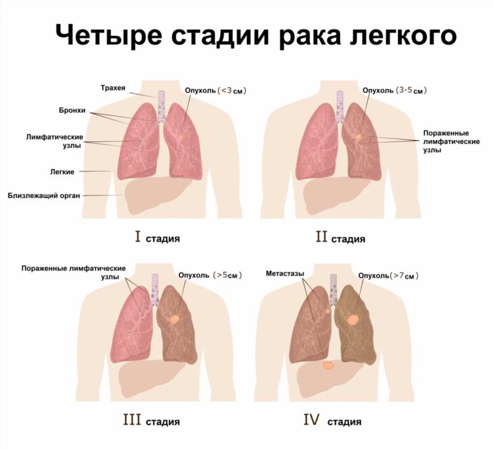 Мелкоклеточный рак легкого: разбираем редкое заболевание