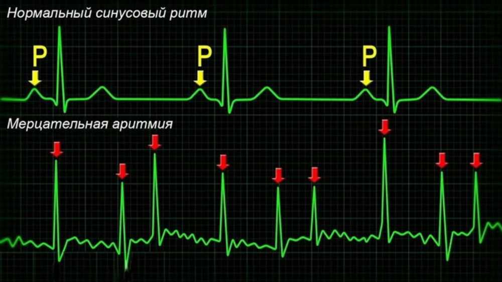 Почему возникает мерцательная аритмия: основные причины и факторы риска