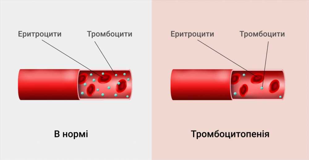 Причины тромбоцитопении: основные факторы и механизмы развития