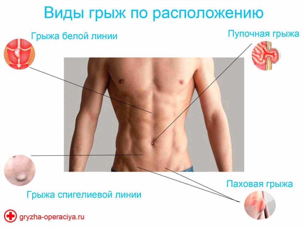 Пупочная грыжа: лечение и возможные осложнения, которые стоит знать