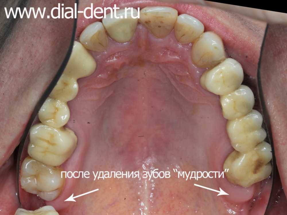 Растут зубы мудрости: Все, что вам нужно знать о процессе и уходе