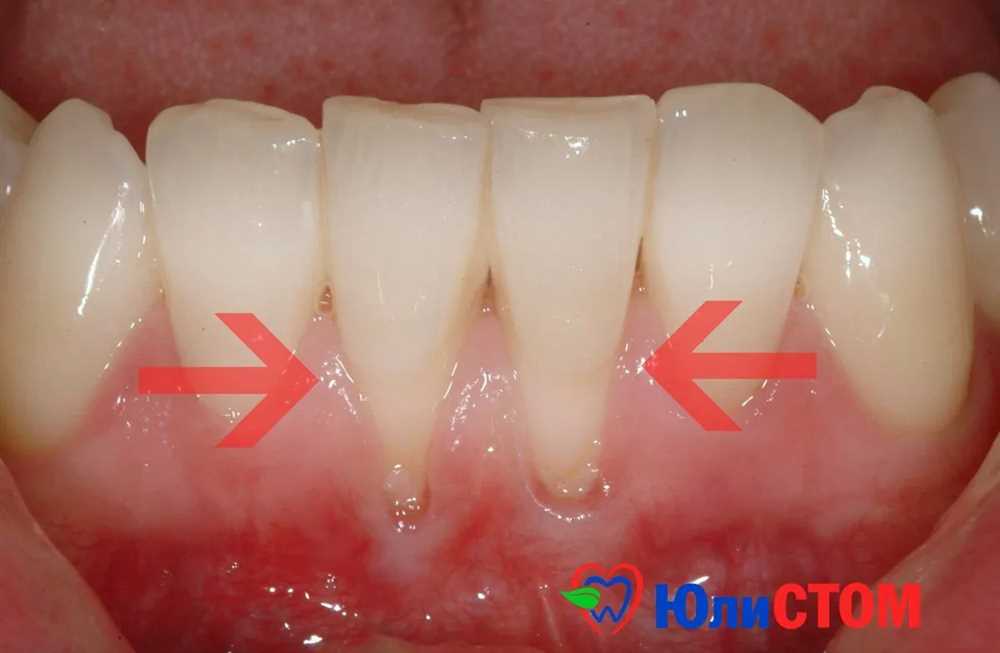 Рецессия десны: Понимание, Лечение и Профилактика