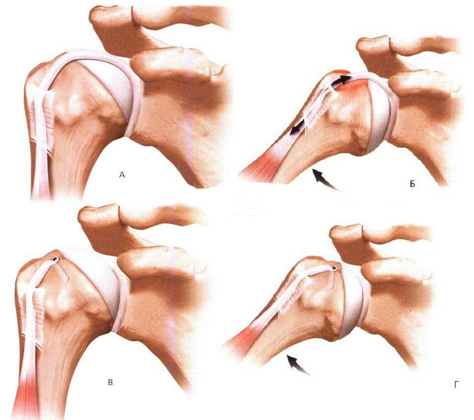 Симптомы и лечение нестабильности плечевого сустава: полное руководство