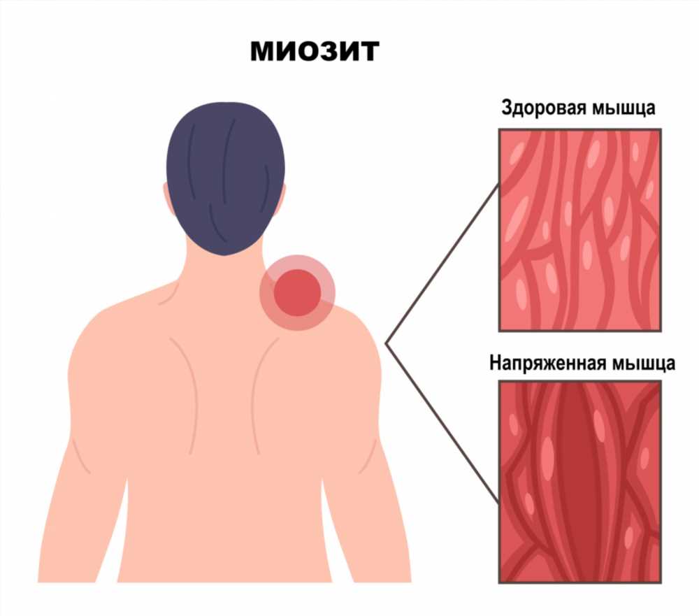 Всё, что вам нужно знать о миозите: симптомы, лечение и профилактика